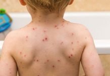 Vírus do sarampo está ativo em 29 municípios paranaenses